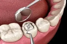 alternatives fillings